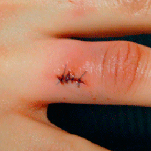 06-02-finger-implant-removal_sm.jpg