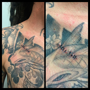 06-07-chest-implant-removal_sm.jpg