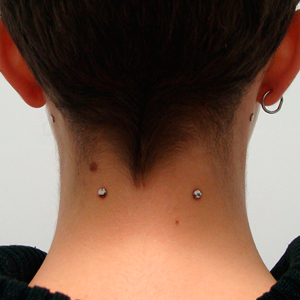 Double neck microdermal