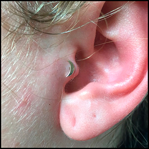 Tragus piercing with moon gold top