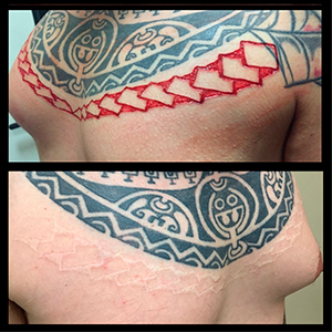 06-16a-polynesian-fresh-and-healed-scarification_sm.jpg
