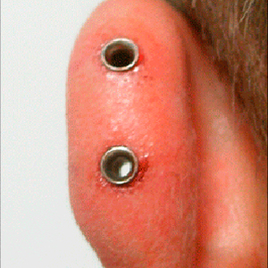 Big helix with dermal punch technique