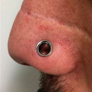 Big nostril with dermal punch technique
