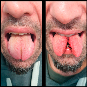 capo-tongue-splitting-april-2022-tongue-re-splitting-2.jpg