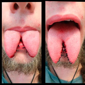 capo-tongue-splitting-april-2022-tongue-spliting-14.jpg