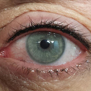 Eyelashes filling micropigmentation