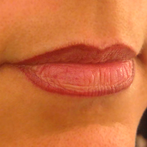 lip dark outline micropigmentation after healing