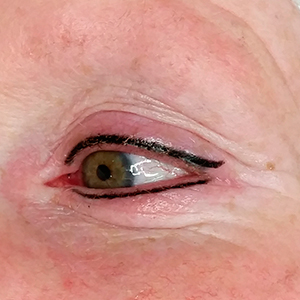 upper & lower eye-lining micropigmentation