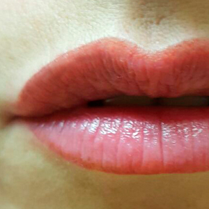Upper lip extension after healing