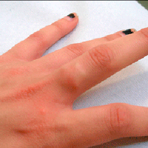06-00-silicon-star-finger-implant_sm.jpg