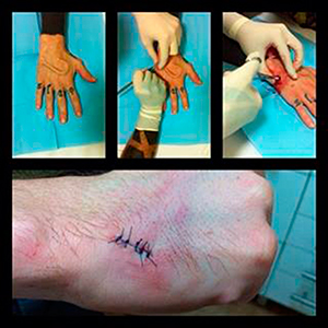 06-04-hand-implant-removal_sm.jpg