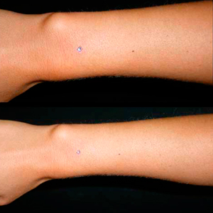 Microdermales en brazo