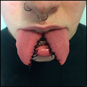 06-36-tongue-splitting_sm.jpg