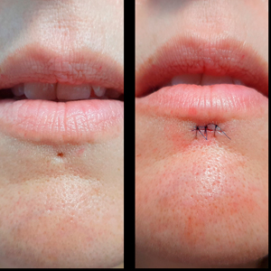 capo-surgery-april-2022-piercing-scar-removal.jpg