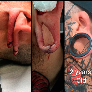 capo-surgery-april-2022-stretched-lobe-repair-7.jpg