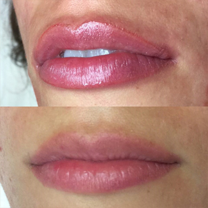 Contorno de labios natural con micropigmentación.