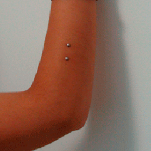 Double arm microdermals